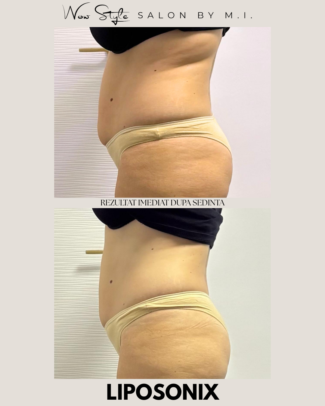 Liposonix, Tulcea, slabire, slabit, cura de slabire, tratament corporal, tratament facial, dieta, slabire tulcea, wowbody, erett, perfectbody, aparat slabit tulcea, corp tonifiat, grasime burta, grasime acumulata, salon infrumusetare, salon tulcea, tratamente tulcea, clinica tulcea,