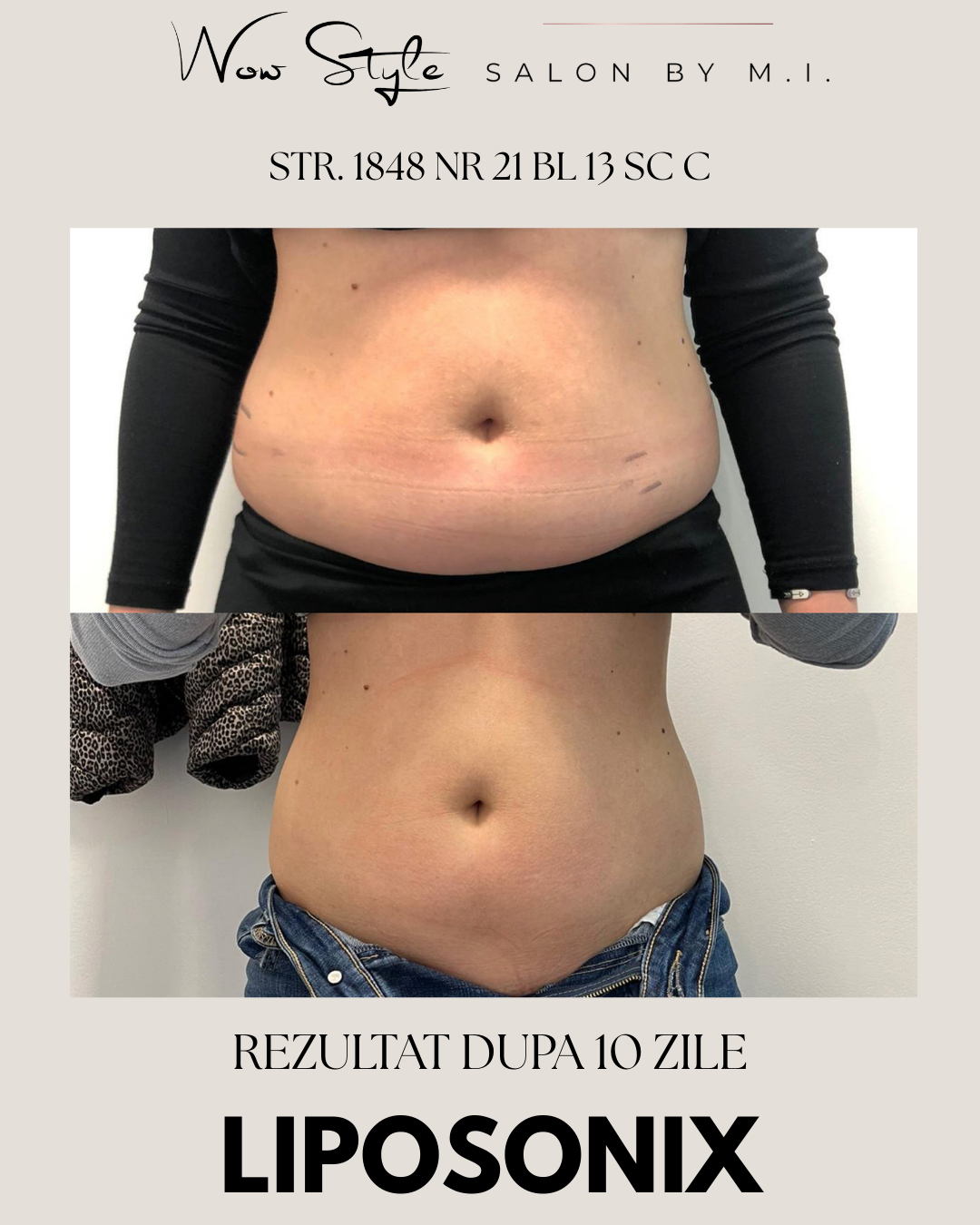 Liposonix, Tulcea, slabire, slabit, cura de slabire, tratament corporal, tratament facial, dieta, slabire tulcea, wowbody, erett, perfectbody, aparat slabit tulcea, corp tonifiat, grasime burta, grasime acumulata, salon infrumusetare, salon tulcea, tratamente tulcea, clinica tulcea,