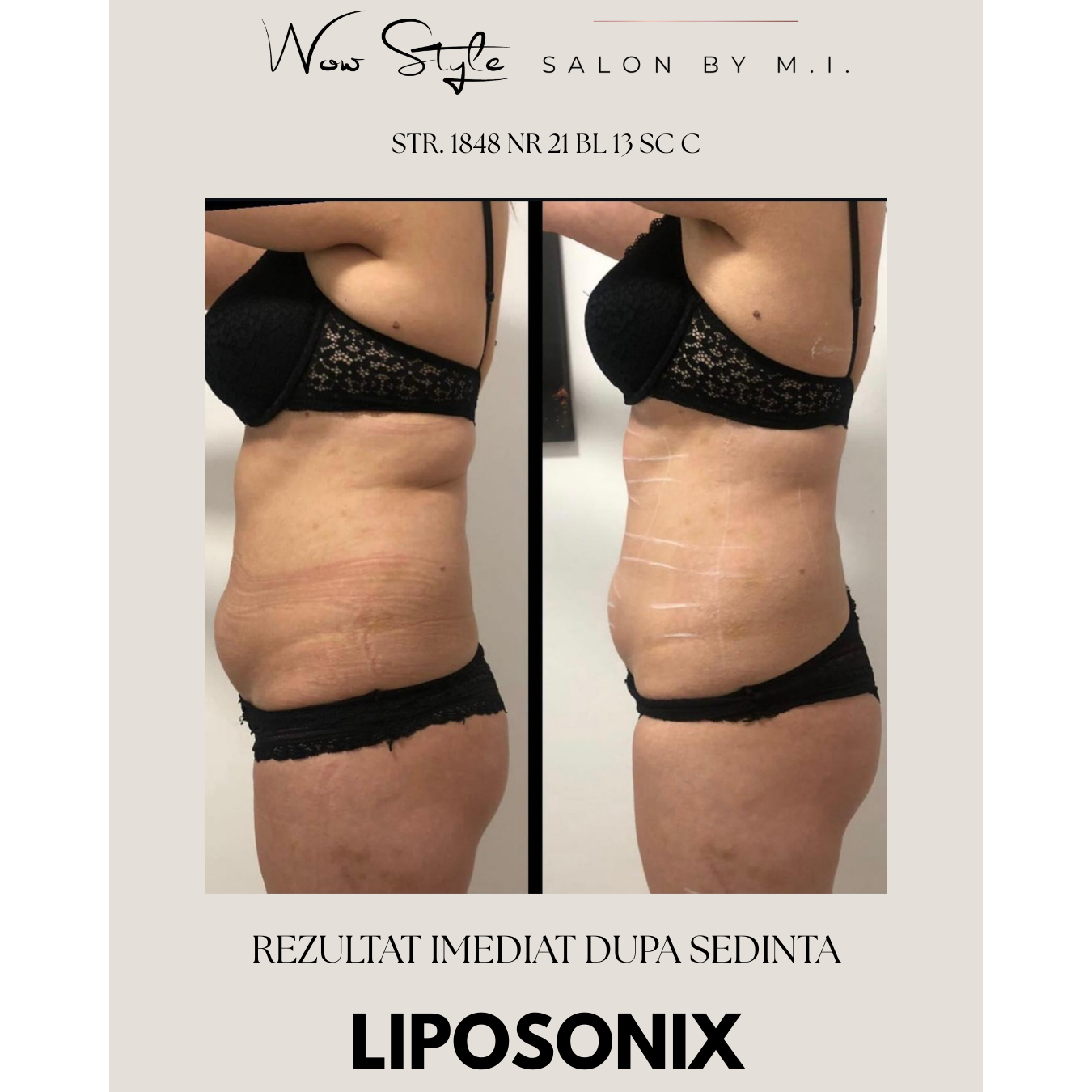 Liposonix, Tulcea, slabire, slabit, cura de slabire, tratament corporal, tratament facial, dieta, slabire tulcea, wowbody, erett, perfectbody, aparat slabit tulcea, corp tonifiat, grasime burta, grasime acumulata, salon infrumusetare, salon tulcea, tratamente tulcea, clinica tulcea,
